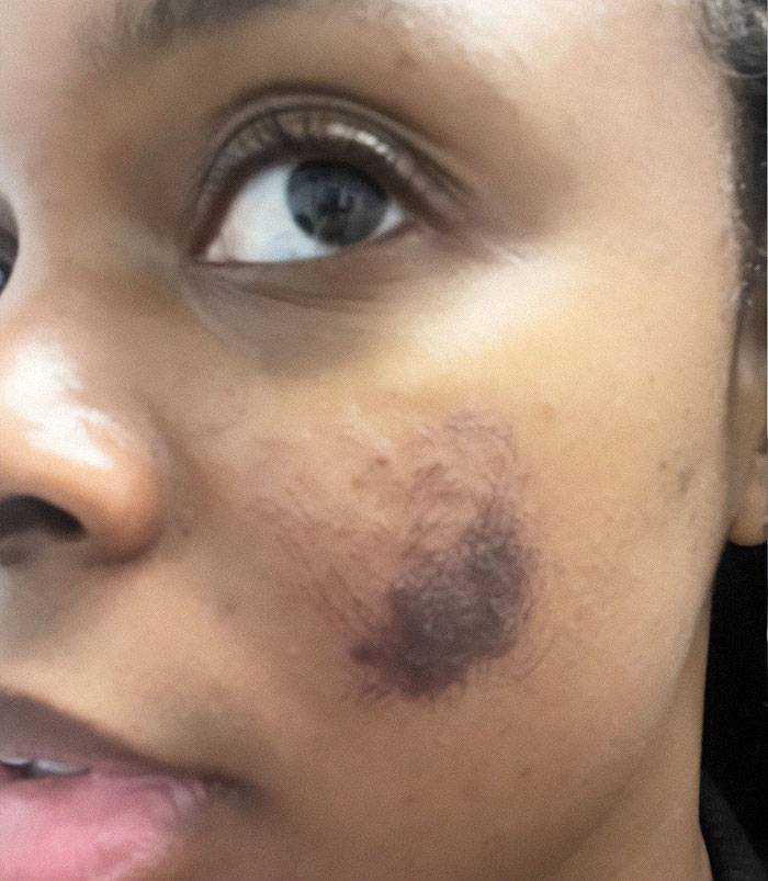 Amid Viral Injuries, Skin Expert Exposes Dangers Of Botched Microneedling Treatments (Exclusive)