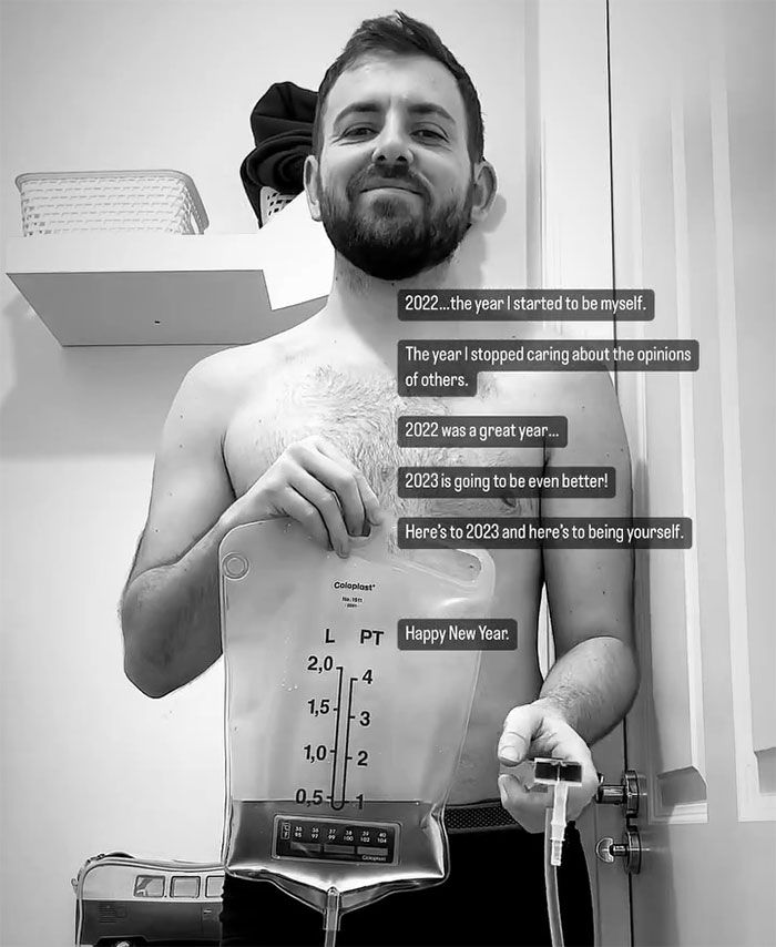 "Ashamed And Embarrassed": Man Without An Anus Reveals His Peculiar Bowel Habits