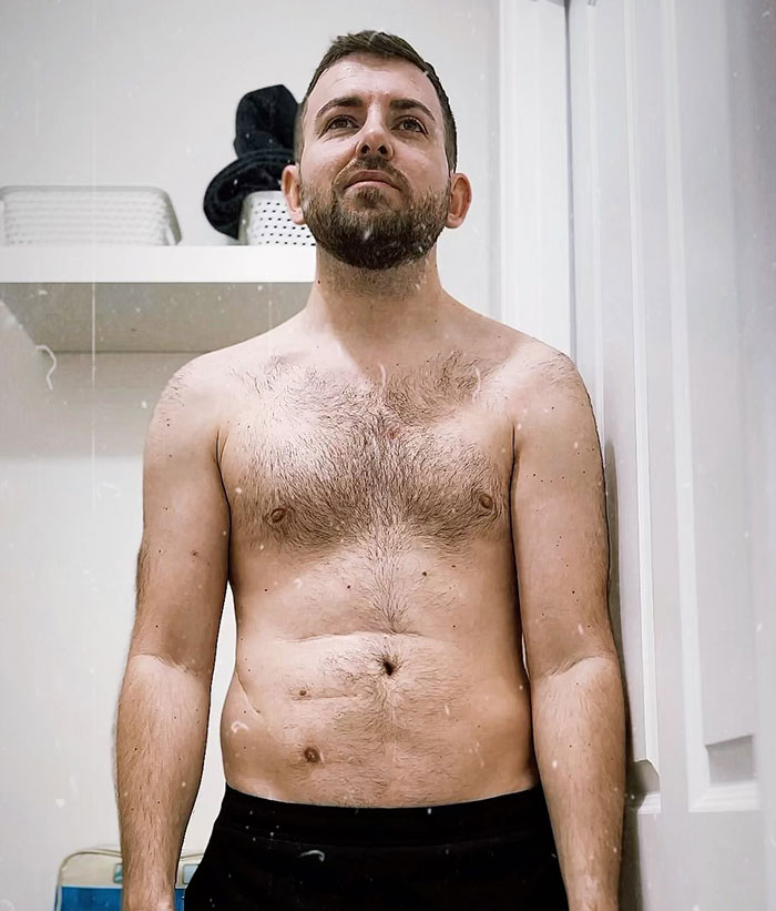 "Ashamed And Embarrassed": Man Without An Anus Reveals His Peculiar Bowel Habits