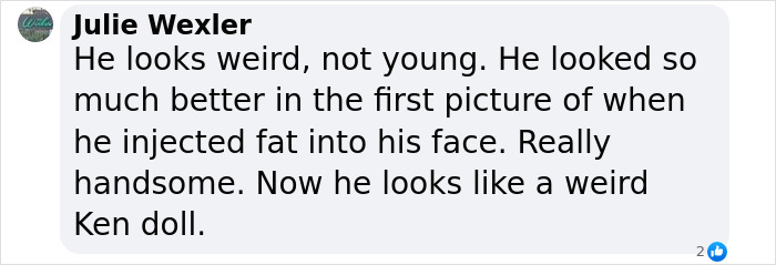 Billionaire Trying To Reverse Aging Injected Fat Into His Face&mdash;Reveals &ldquo;Disturbing&rdquo; Results