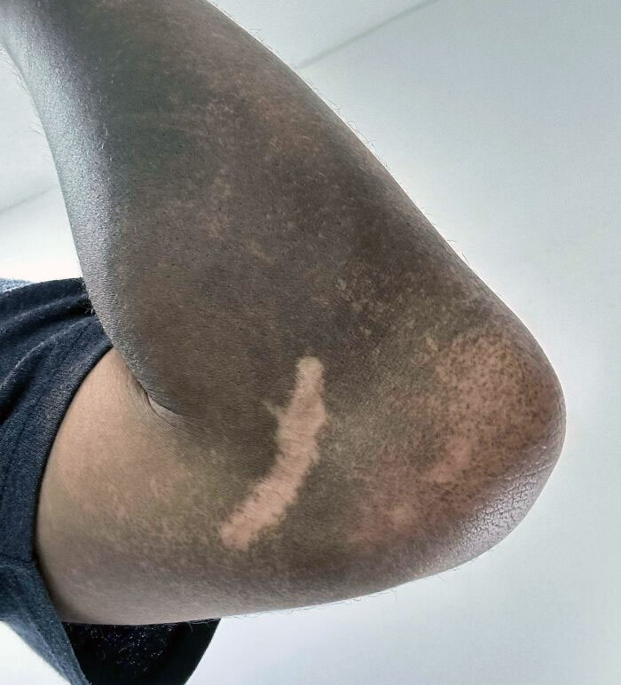 The Scar On My Arm Doesn’t Get Dirty