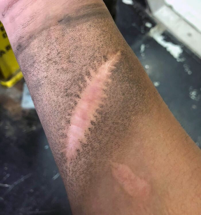 My Scar Doesn’t Get Dirty When I’m At Work