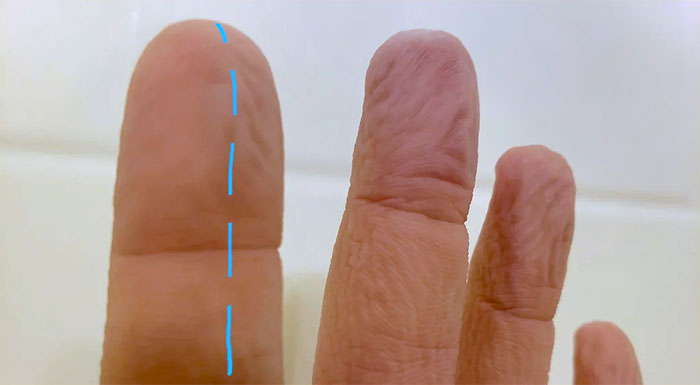 Severed A Nerve In My Index Finger... Half My Finger Can No Longer Prune