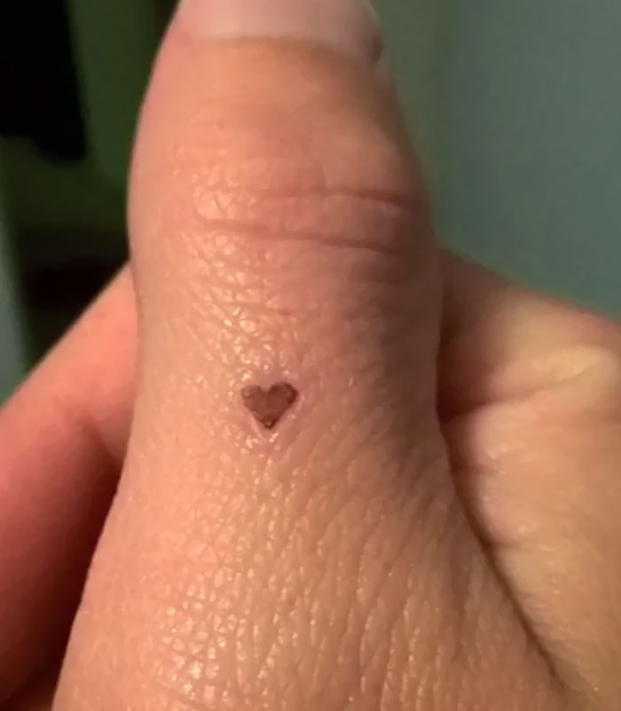 My Injury Healed In A Nearly Perfect Heart Shape