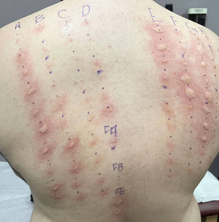 My Allergy Skin Test From Today