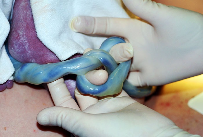 When My Son Was Born He Had A Knot In His Umbilical Cord