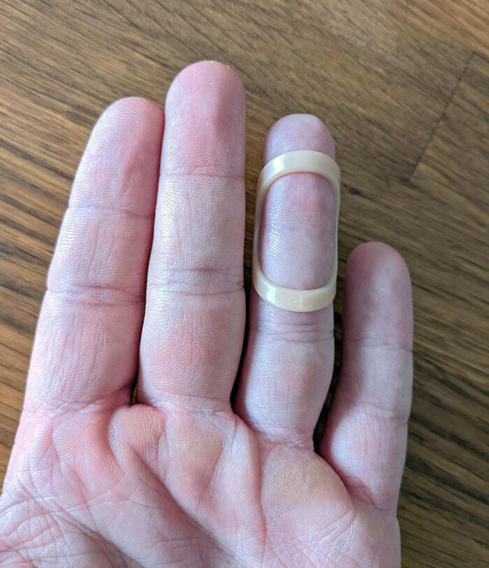 Starting To Lose The First Joint Crease On My Ring Finger After Being Splinted For 7 Weeks