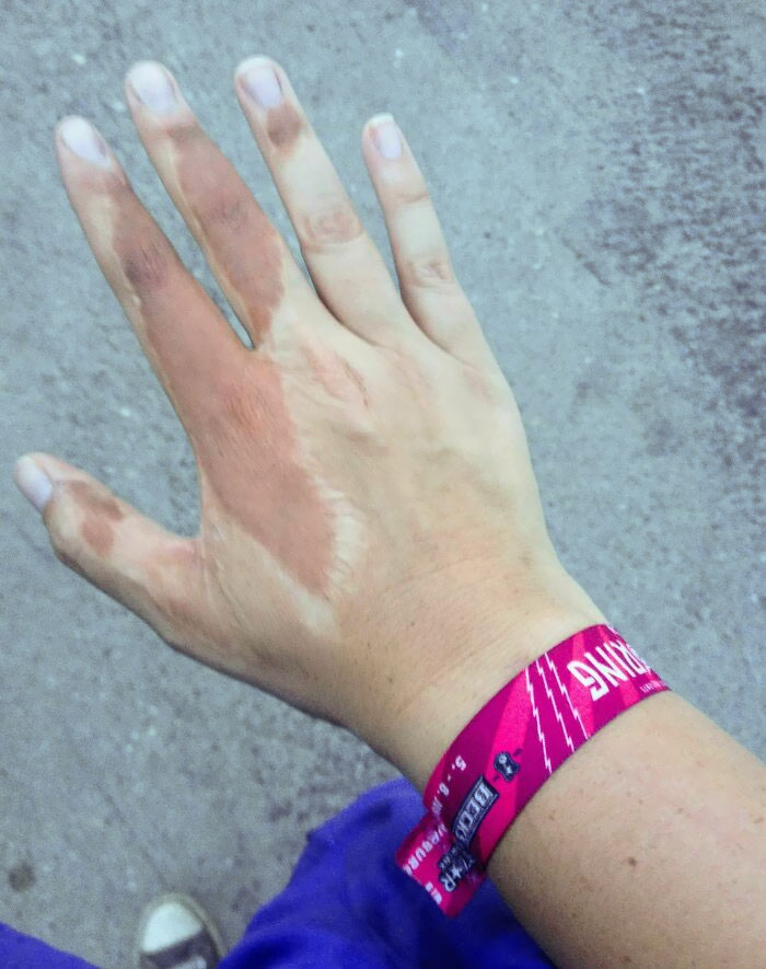 The Scar On My Hand, From A Skin Transplant From My Upper Arm, Gets More Tanned Than The Rest