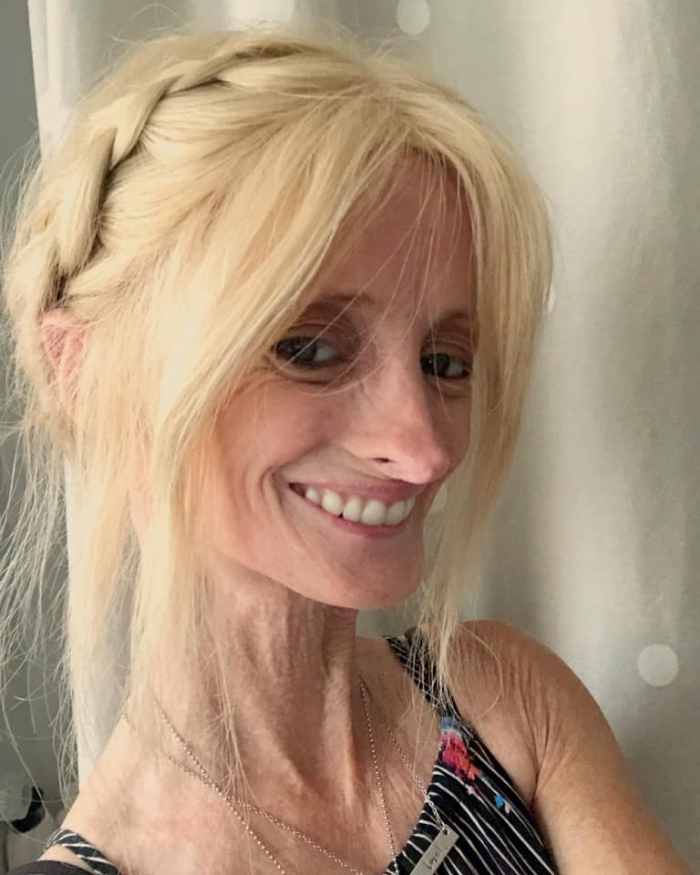 &ldquo;Right Now Is All We Have&rdquo;: Woman With Rare &lsquo;Benjamin Button&rsquo; Condition Claps Back At Trolls