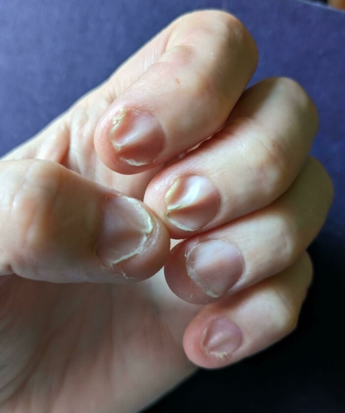 Close-up of a hand with damaged nails, illustrating an interesting medical case of nail health issues.