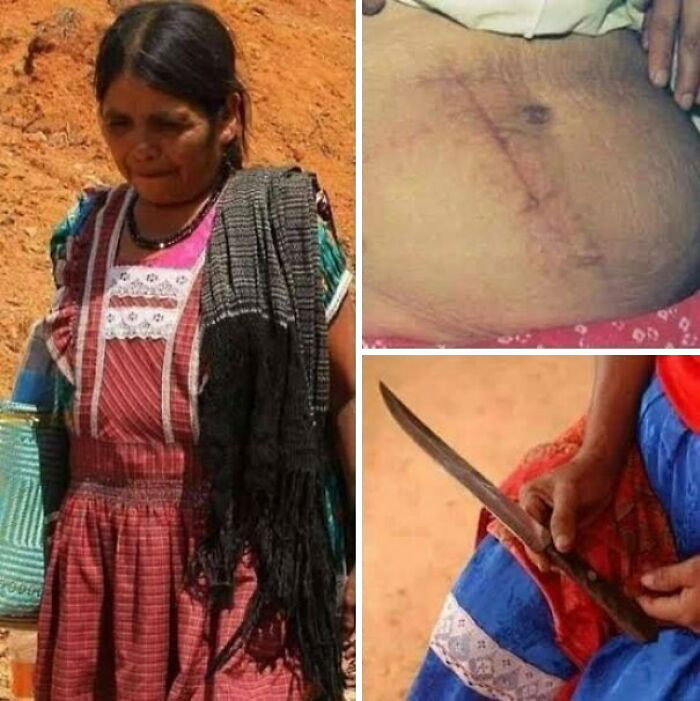 Woman in traditional clothing, scar on abdomen, holding a knife; interesting medical case illustrating resilience.