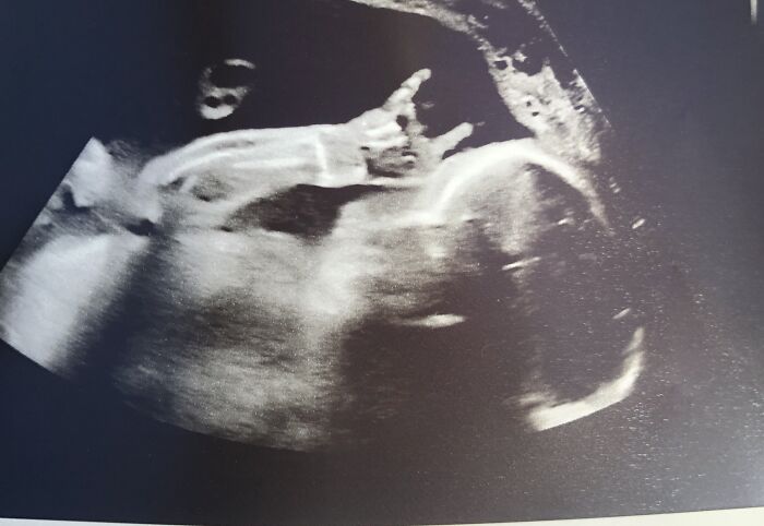 Ultrasound image showing a fetus with a humorous hand gesture, capturing funny pregnancy situations.