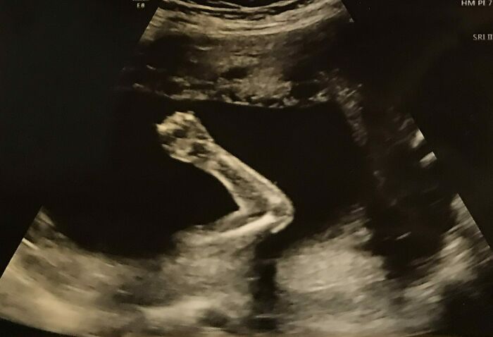 Ultrasound showing a baby fist, capturing a funny pregnancy situation.