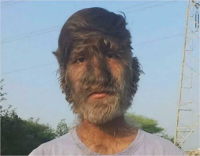 Person with unique facial hair growth illustrating an interesting medical case.