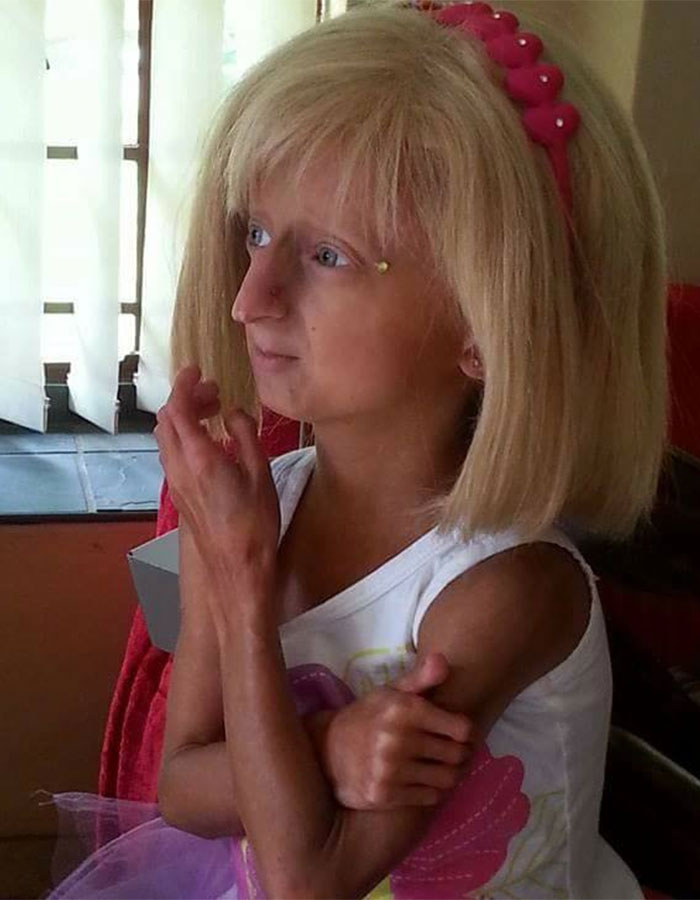 Teen Who Aged 8 Times Faster And Dreamed Of Marrying Passes Away Before Christmas