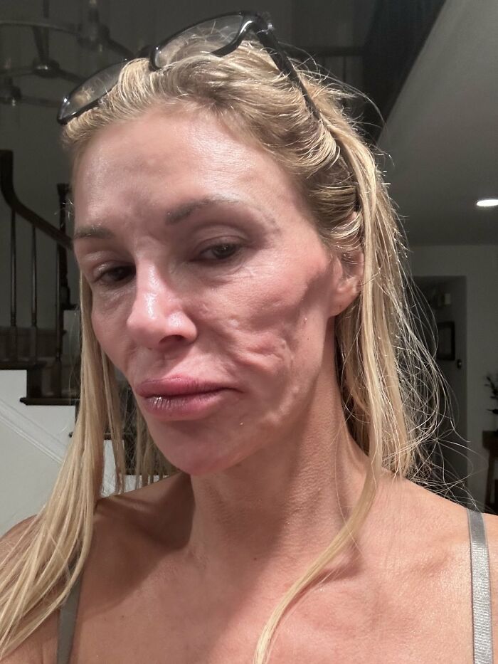 Swollen-Faced Brandi Glanville Says She Can Feel The &ldquo;Parasite&rdquo; Having &ldquo;Babies In [Her] Face&rdquo;