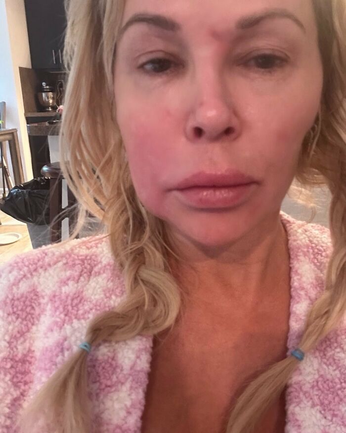 Swollen-Faced Brandi Glanville Says She Can Feel The &ldquo;Parasite&rdquo; Having &ldquo;Babies In [Her] Face&rdquo;