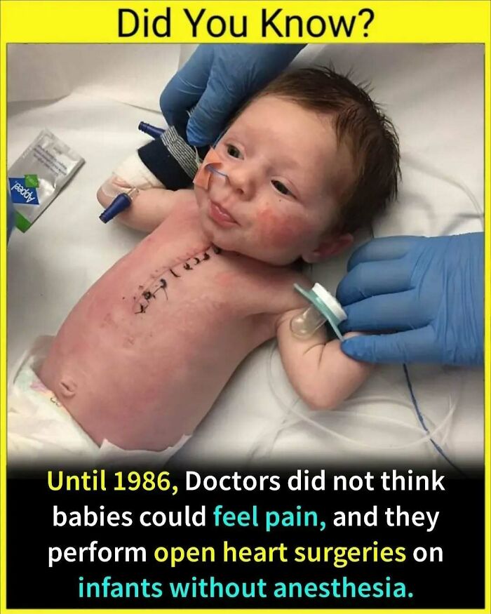Baby with a surgical incision on the chest, highlighting a historical medical practice; part of undiscovered facts series.