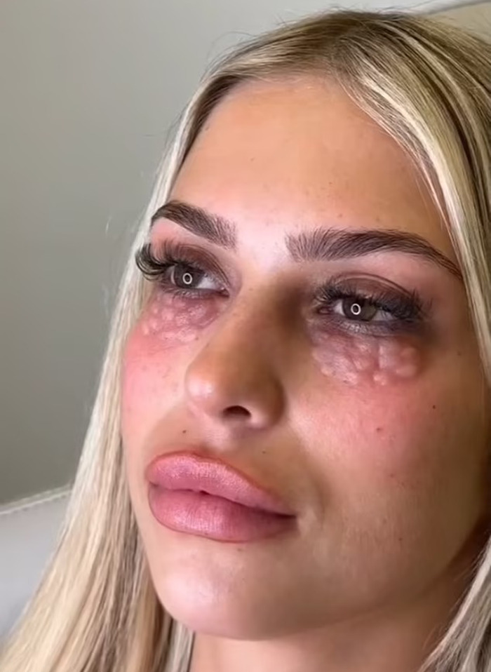 Woman with skin texture resembling reptile scales from beauty trend. Woman with skin texture resembling reptile scales from beauty trend.