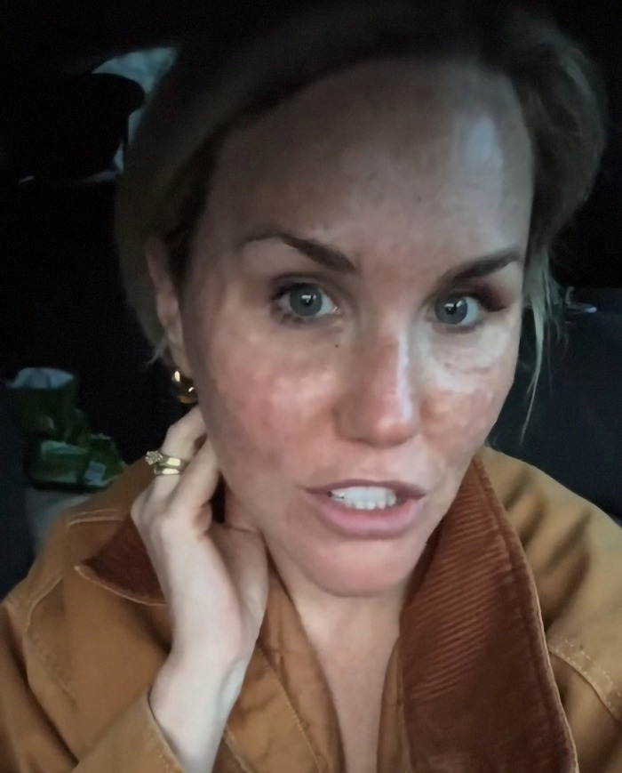 Woman showing skin effects from dangerous beauty trend, visibly resembling reptile-like texture in a car selfie. Woman showing skin effects from dangerous beauty trend, visibly resembling reptile-like texture in a car selfie.