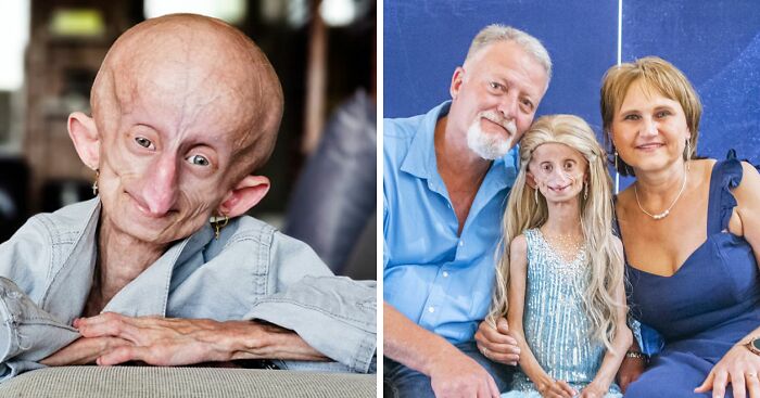 Teen Who Aged 8 Times Faster And Dreamed Of Marrying Passes Away Before Christmas