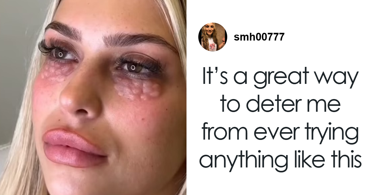 Doctors Warn Against Dangerous Beauty Trend That Leaves People Looking