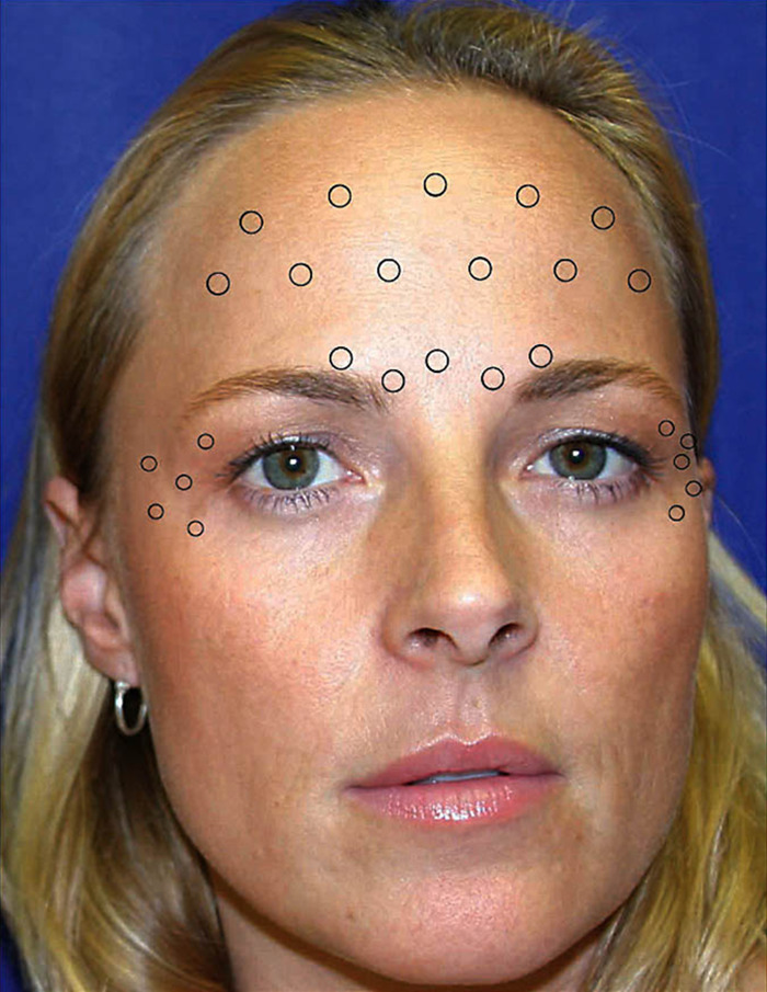 Close-up of a woman with Botox injection points on her face.