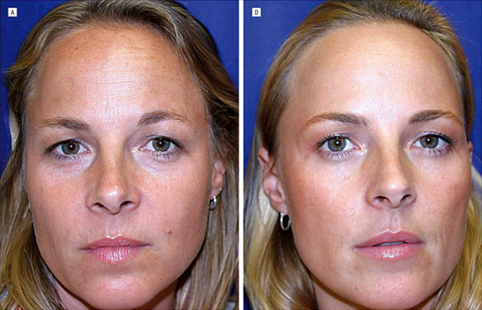 Twin sisters compared: one ages naturally, the other uses Botox, highlighting different aging effects.