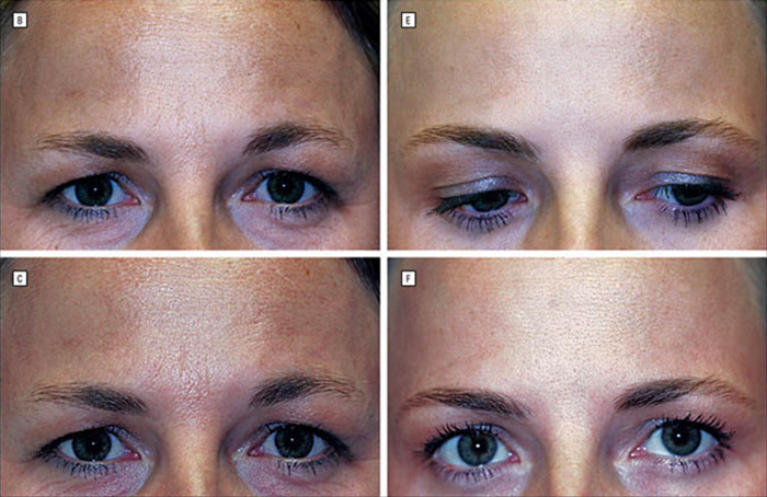 Twin comparison: one ages naturally, other with Botox; netizens react.