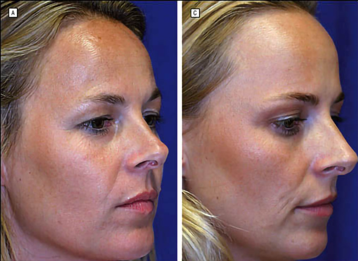 Twin comparison: one aging naturally, the other with Botox treatment.