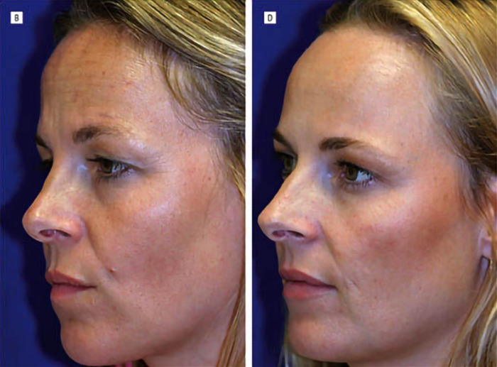Twin sisters showing natural aging on the left and Botox effects on the right in a side-by-side comparison.