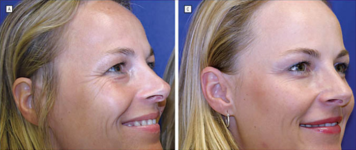 Twin sisters, one showing natural aging, and the other with Botox treatment.