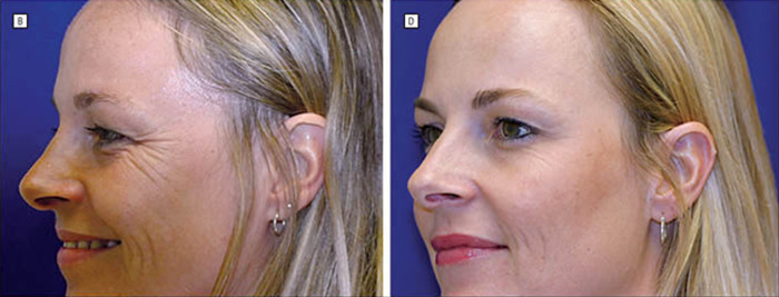 Twin sisters comparison: one with natural aging and the other with Botox, showcasing differences in facial appearance.