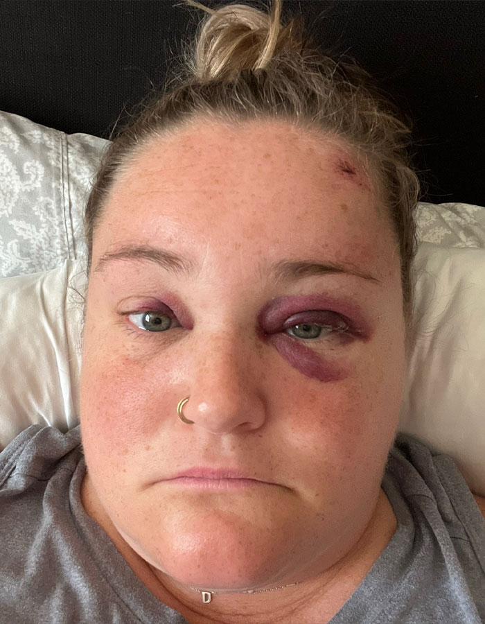 Netizens Say Makeup Artist &ldquo;Nailed It&rdquo; After Hiding Bride&rsquo;s Facial Bruise 5 Days Before Wedding