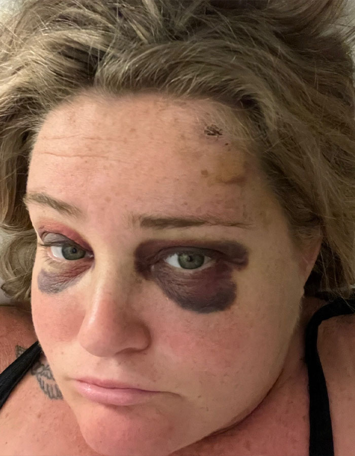 Netizens Say Makeup Artist &ldquo;Nailed It&rdquo; After Hiding Bride&rsquo;s Facial Bruise 5 Days Before Wedding