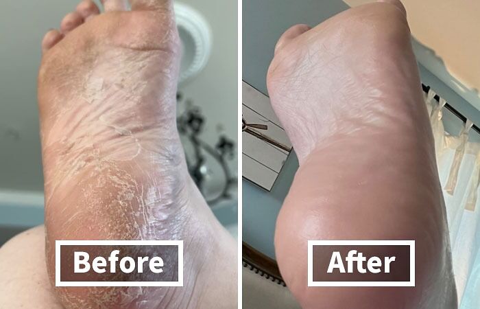 Before and after foot care transformation, highlighting smoother skin, makes you feel more put together.