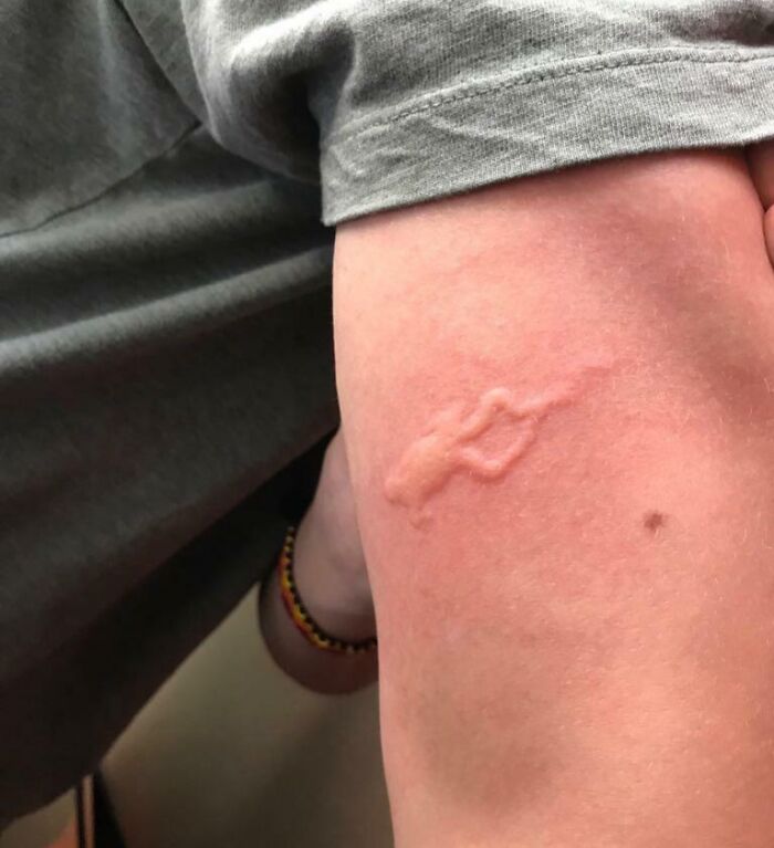 Close-up view of a skin mark resembling an animal shape, illustrating pareidolia in everyday objects.