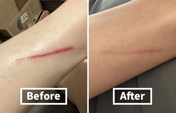 Before and after image showing a healing scar, addressing unavoidable body issues and skin improvement.