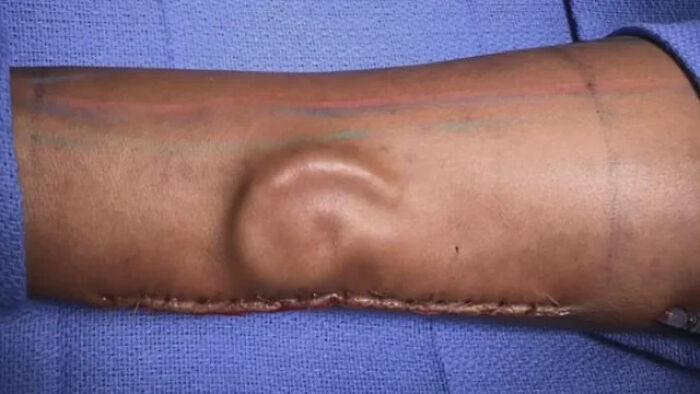 Human arm with an ear-shaped structure, showcasing interesting and fascinating medical feat.