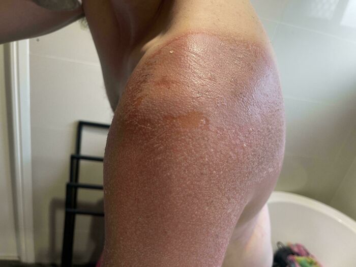 Sunburned shoulder with peeling skin, displaying an Australian summer misadventure.