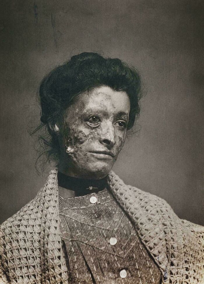 Victorian Era woman with facial scars, wearing a patterned shawl and buttoned dress. Black and white historical photograph.