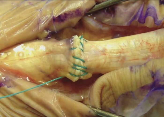 Close-up of sutured intestinal segment with blue surgical sutures during dissection, medical pics