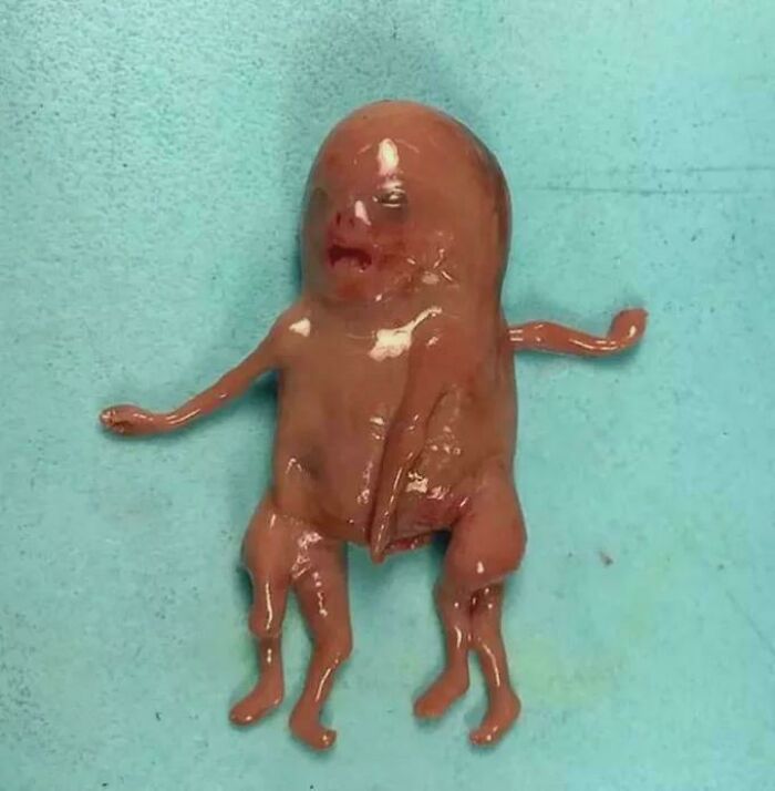 Malformed fetal specimen on blue surgical drape, glossy tissue and tiny limbs, medical pics