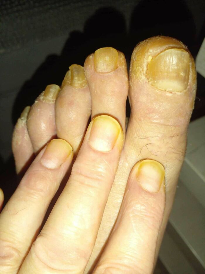 Close-up of yellowed, thickened fingernails and toenails, medical pics example
