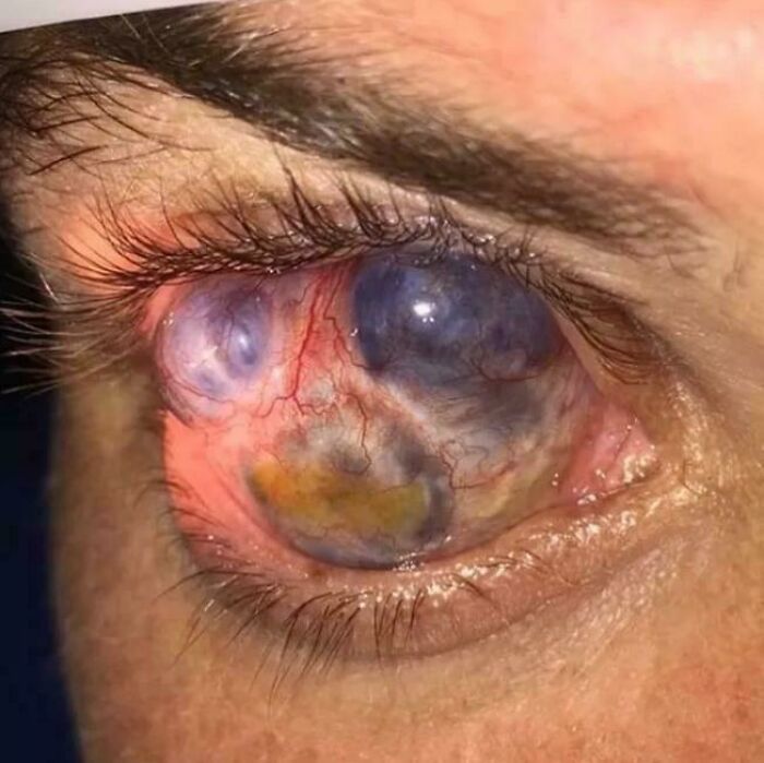 Close-up of a severely diseased cloudy bulging eye with dilated blood vessels and yellow lesion, medical pics