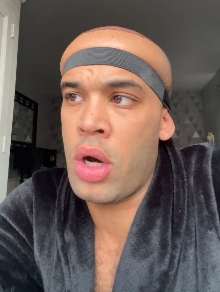 Kanah Flex shows hair transplant results with headband, looking surprised. Kanah Flex shows hair transplant results with headband, looking surprised.