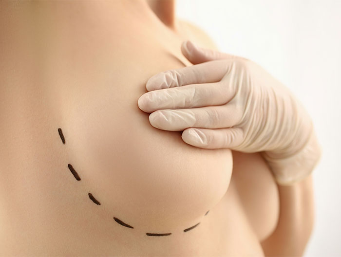 Person with marked chest for breast reduction consultation, wearing gloves. Person with marked chest for breast reduction consultation, wearing gloves.