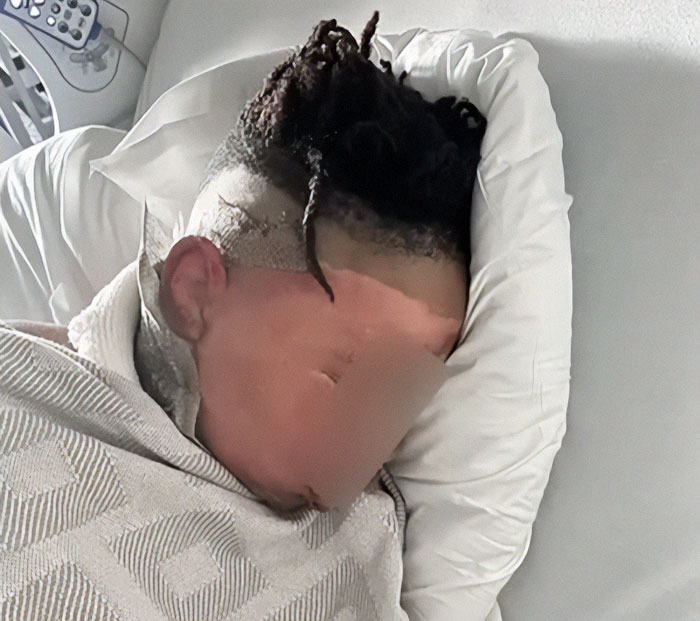 12-year-old boy in hospital bed after prank with hot water.