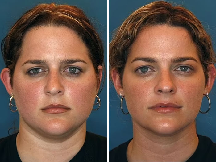 Twins showcasing effects of divorce and bad diet on facial appearance in a viral comparison study.