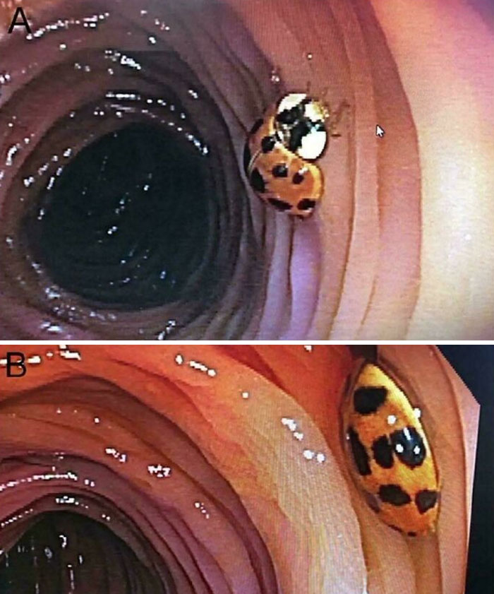 World’s First Case Of An Alive Ladybug Found In Someone’s Colon During Colonoscopy